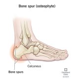 bone-spur-osteophyte.jpg